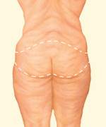 Dr. Haworth abdominoplasty plastic surgery