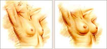 Beverly Hills breast augmentation Dr. Haworth