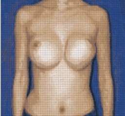Beverly Hills breast implant revision