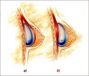 Dr. Haworth breast implant technique