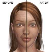 facelift beverly hills