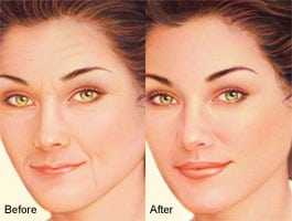 facelift beverly hills