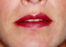 Dr. Haworth lip plastic surgery expert