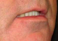 Beverly Hills lower lip plastic surgery