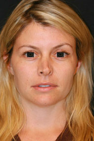 Classic Facelift Before & Before