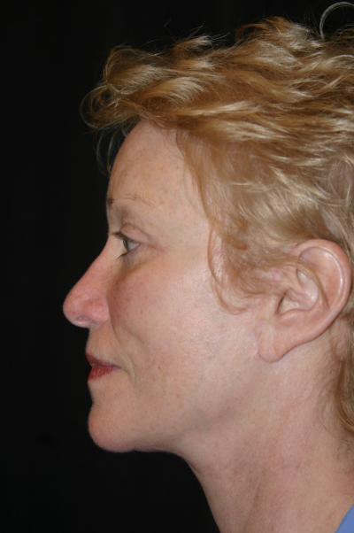 Classic Facelift After & After