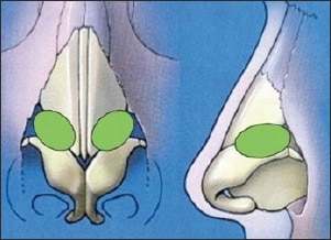 alar batten grafts - rhinoplasty revision procedure