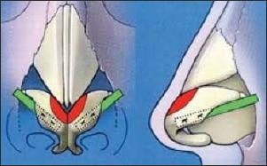 lateral crural strut grafts - rhinoplasty revision procedure
