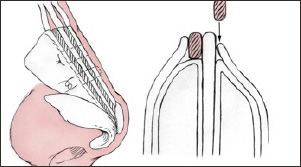 spreader graft - rhinoplasty revision procedure