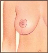 vertical-mastopexy