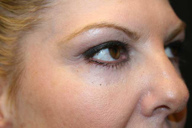 After a lower blepharoplasty (eyelid tuck)