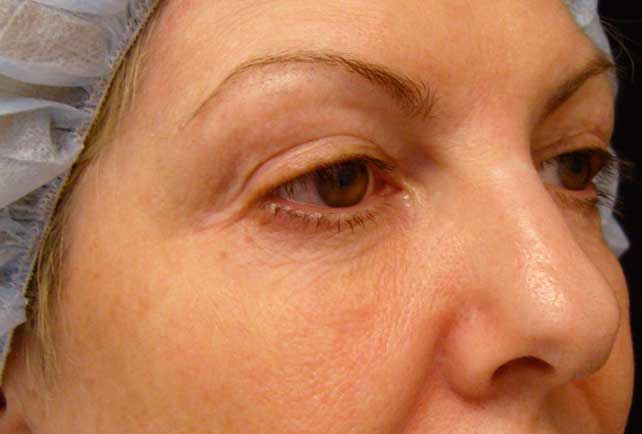 Oblique view of aging lower eyelid