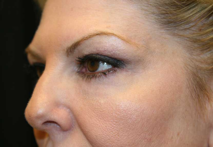 After a lower blepharoplasty performed by Dr. Randal Haworth in Beverly Hills