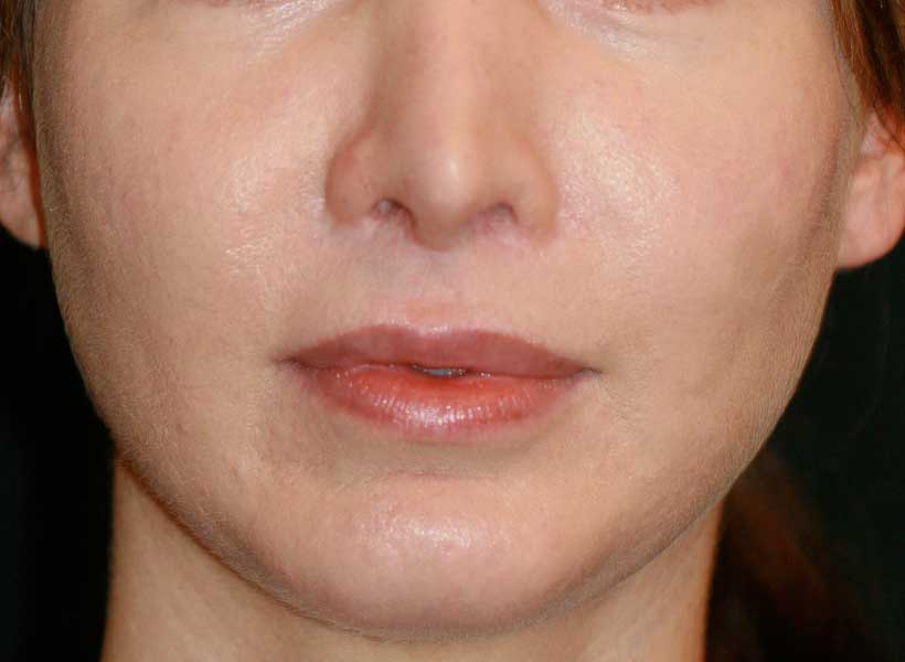 Dr. Haworth performed an upper lip lit along with nostril rim lowering and fat transfer to the lips
