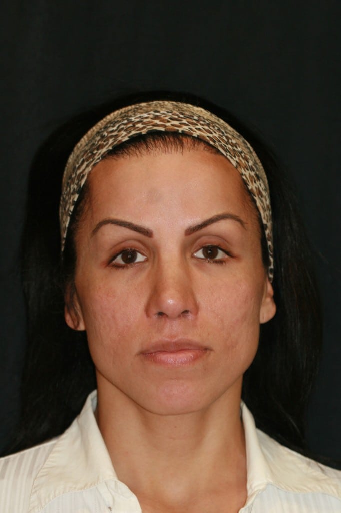 Transgender patient after composite grafts to lower the nostril rims and an upper lip lift with DAO release
