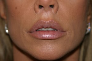 The results of a skin-only lip lift. Notice the widened scars, significant nostril distortion and recurrent long upper lip.