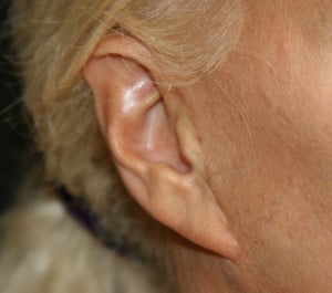 Pixie earlobe after a facelift. Note scar in front of the ear