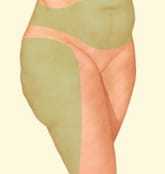 Beverly Hills liposuction procedure