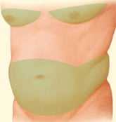 Beverly Hills liposuction procedure