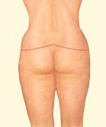 Beverly Hills tummy tuck expert