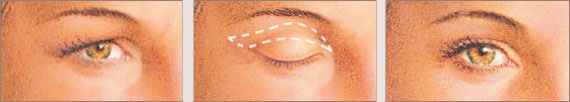 Dr. Randal Haworth plastic surgery eyes