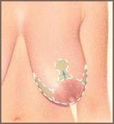 Mastopexy (Breast Lift) 38D to 38C - Conkright Aesthetics