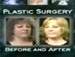 Discovery Health Before & After: Dr Haworth performs rhinoplasty, chin implant & neck liposuction - 2003