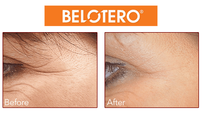 Belotero Beverly Hills wrinkle erasing