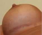 Beverly Hills breast augmentation