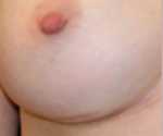 Dr. Haworth breast augmentation