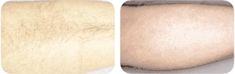 Beverly Hills Skin Lab leg hair removal