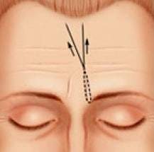 wrinkle relase