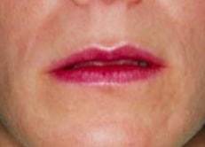 Dr. Haworth lip plastic surgery expert