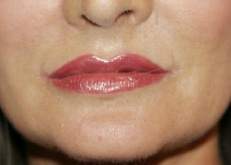 California plastic surgery lip