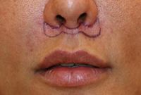 Beverly Hills upper lip lift