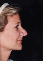 Classic Facelift Before & Before