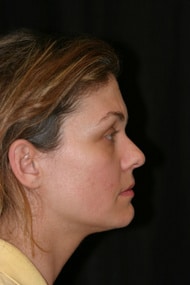 Classic Facelift Before & After