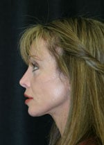 Classic Facelift After & After