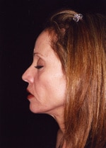 Classic Facelift Before & After