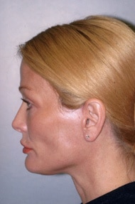 Classic Facelift After & After