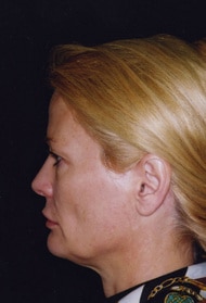 Classic Facelift Before & After