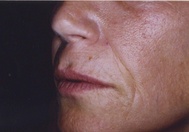 Classic Facelift Before & Before