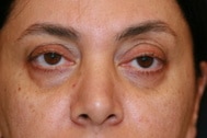 Classic Facelift Before & Before