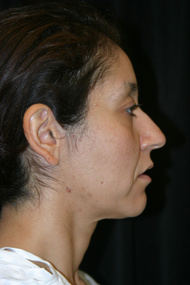 Classic Facelift Before & After