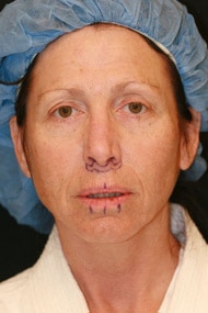 Classic Facelift Before & Before
