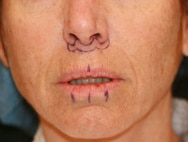 Classic Facelift Before & After