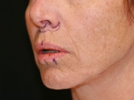 Classic Facelift Before & After