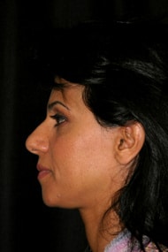 Classic Facelift Before & After