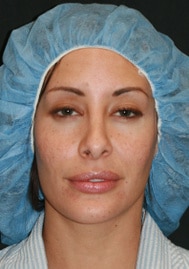 Classic Facelift Before & Before