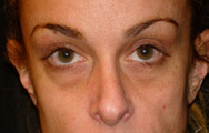 Classic Facelift Before & Before